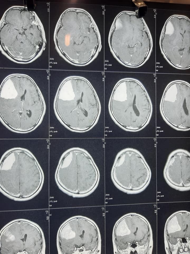Phẫu thuật thành công ca U não vùng trán kích thước lớn cho một bệnh nhân