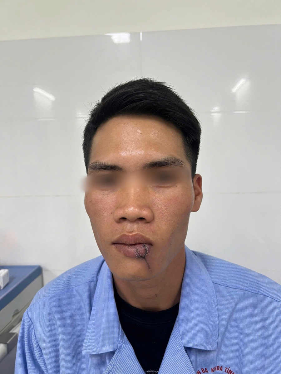 KHOA RĂNG HÀM MẶT – BVĐK TỈNH SƠN LA PHẪU THUẬT TẠO HÌNH THÀNH CÔNG CHO BỆNH NHÂN BỊ KHUYẾT HỔNG MÔI DƯỚI PHỨC TẠP DO TAI NẠN